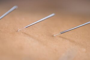 Dry Needling